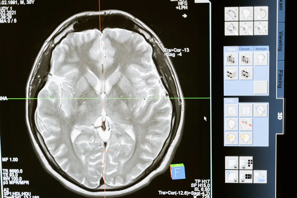 A digital rendering of technology connecting to the human head, representing neural interface concepts.